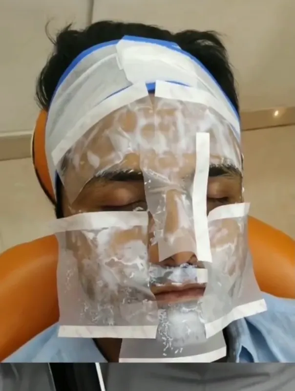 PRP Face TREATMENT6